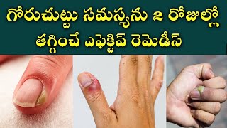 Effective Home Remedies for Nail Fungus  How to Prevent and Treat a Paronychia  Goru Chuttu [upl. by Bohs]