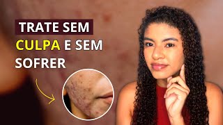 Tratamento de Acne 5 Fatos sobre o processo de CONTROLE DA ACNE que não te revelam [upl. by Francisca]