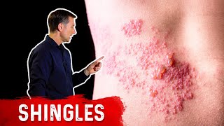 Shingles Natural Relief [upl. by Kavanagh295]