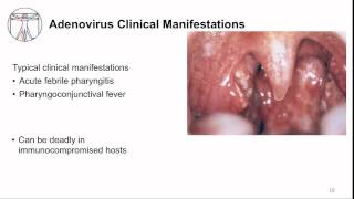 Respiratory Viruses Upper Respiratory Tract [upl. by Guy]