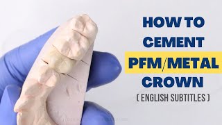 How to Cement a PFMMetal Crown [upl. by Anawt]