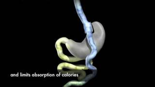 Laparoscopic RouxenY Gastric Bypass Surgery Animation [upl. by Yetac507]