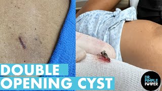 Double Opening Back Cyst [upl. by Repohtsirhc]