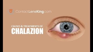 Chalazion  Causes Treatment and Surgery [upl. by Haela]