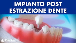 Impianto dentale immediato postestrazione dente © [upl. by Khichabia]