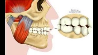 Rechinido dental [upl. by Pallaton]