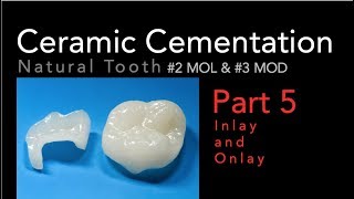 Lithium Disilicate Ceramics Part 5 Cementation of Inlay and Onlay [upl. by Sklar]