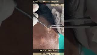 Mole on forehead Removal by RF  Painless mole removing mole remove moles awishclinic shorts [upl. by Dov]