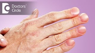 What causes painful horizontal ridges on nails with discomfort  Dr Urmila Nischal [upl. by Toy840]