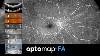 optomap  10 imaging modalities [upl. by Cy]