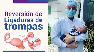 Reversión de la ligadura de trompas l Dr Juan Luis Giraldo [upl. by Atinoj125]