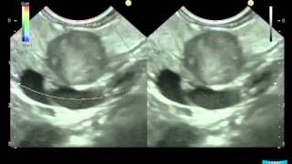 EUS in Solid Pancreatic Lesions Detection Characterization amp Assessment of Resectability [upl. by Fransen]