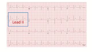 Corrected QT interval QTc on electrocardiogram part 2 [upl. by Anthea471]