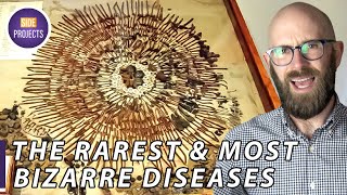 Some of the Worlds Rarest and Most Bizarre Diseases [upl. by Nali]