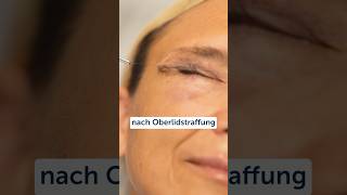 oberlidstrafffung oberlid lidkorrektur lid plastischechirurgie düsseldorf [upl. by Alael376]