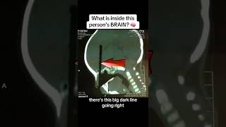 This child got very lucky shocking fascinating coolfacts medical medtok doctor brain [upl. by Jenness]