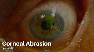 Eye injuries Corneal abrasion [upl. by Leacim]