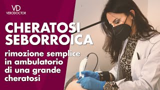 CHERATOSI SEBORROICA  come rimuovere una cheratosi in 15 minuti  VERODOCTOR [upl. by Yessak]