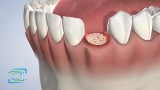 PostOperative Instructions Bone Grafting in Fresno CA  Fresno Oral Maxillofacial Surgery [upl. by Doti775]