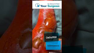 Cellulitis  Complete Information  What is Cellulitis  Treatment Options  Reasons  Debridement [upl. by Annawyt]