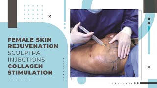 Female Skin Rejuvenation  Sculptra Injections  Collagen Stimulation [upl. by Jabez]