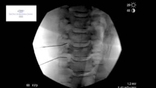 Cervical Transforaminal Epidural Sterioid Injection [upl. by Rosa]