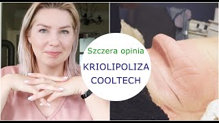 KRIOLIPOLIZA COOLTECH 🔵 BARDZO SZCZERA OPINIA 🔵 PRAWIE idealna [upl. by Melbourne]