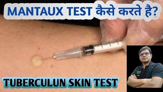 Mantoux test  TST  PPD  Tuberculin skin test  Diagnosis of TB [upl. by Mitchael465]