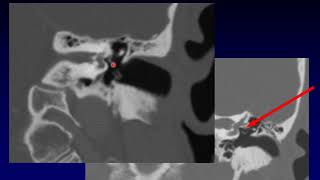 Temporal Bone Pathology 5 Facial Nerve [upl. by Suired479]