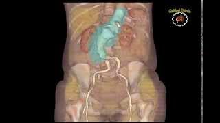 ANEURISMA DE AORTA ABDOMINAL  ANGIOTOMOGRAFIA [upl. by Dunston]