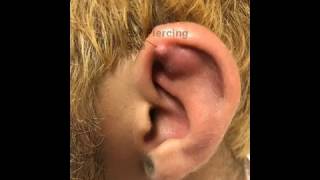 Left Ear Helix Abscess Chondritis or Not [upl. by Brackely317]