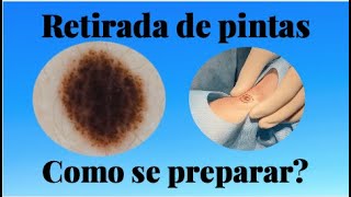 Qual é o PREPARO para RETIRADA de PINTAS Por Luiz Gameiro dermatologista [upl. by Kleper16]