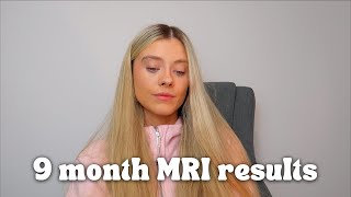 brain cancer update MRI results clinical trial and where my tumour is [upl. by Noiwtna661]