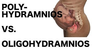 Polyhydramnios vs Oligohydramnios [upl. by Couchman]