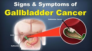 Signs amp Symptoms of Gallbladder Cancer by Gastroclinix [upl. by Dijam]