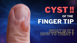 Finger Mucous Cyst  Learn to treat in 3 minutes [upl. by Charlotta928]