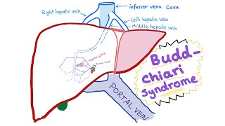 BuddChiari syndrome  Definition Causes Pathophysiology Diagnosis amp Treatment  Hepatology [upl. by Ahseen]