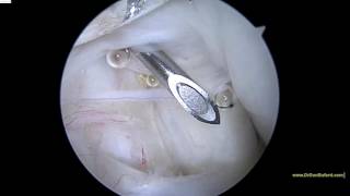 Arthroscopic view of the shoulder middle glenohumeral ligament MGL [upl. by Eeraj993]