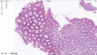 Hyperplastic Polyp  Colon  Histopathology [upl. by Shotton]