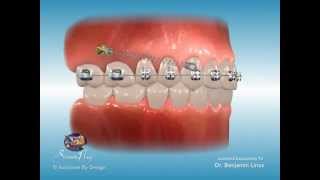 ScreenPlay Orthodontic Education Videos Temporary Anchorage Devices TADs [upl. by Suilenrac]