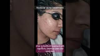 Nodular acne treatment  DrArif Iqbal  Before and After treatment [upl. by Sarene]