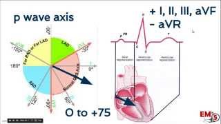 EKG interpretation axis [upl. by Beka114]