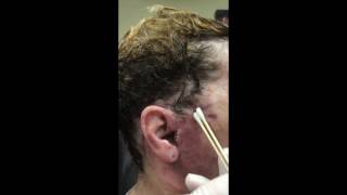 Neck amp Face Initial Dressing Removal and Cleaning [upl. by Aihsekel]