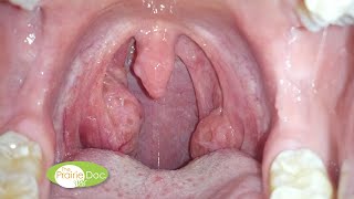 Saved From a Peritonsillar Abscess  By Richard P Holm MD [upl. by Hochman916]