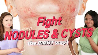 How To Get Rid of Nodular and Cystic Acne FOR GOOD  Root Times Acne Guide [upl. by Fira]