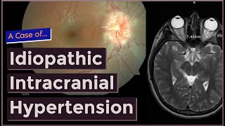 Idiopathic Intracranial Hypertension [upl. by Gebelein]