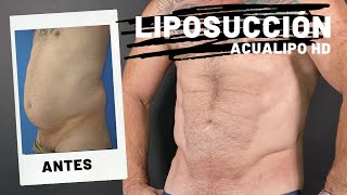 LIPOSUCCIÓN ABDOMEN Y FLANCOS EN HOMBRE MADURO CON DEFINICIÓN [upl. by Drucilla]