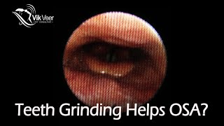 Teeth Grinding helps Sleep Apnoea [upl. by Car]