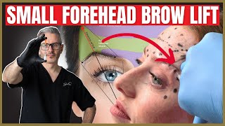 How To Perform a Botox Brow lift on a small forehead [upl. by Herschel239]