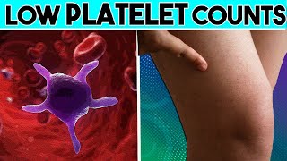 Causes Signs and symptoms of Low platelet count Thrombocytopenia  Low Platelet count [upl. by Bottali482]